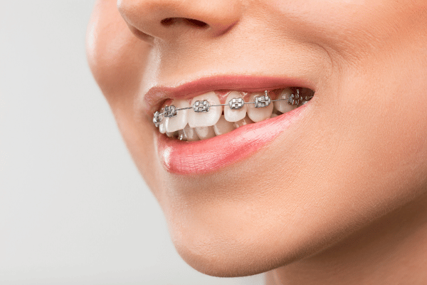 brackets metalicos en clinica dental Colvi en Algeciras