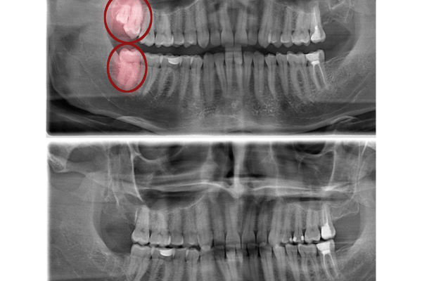 cirugia odontologica en Algeciras por colvi dental