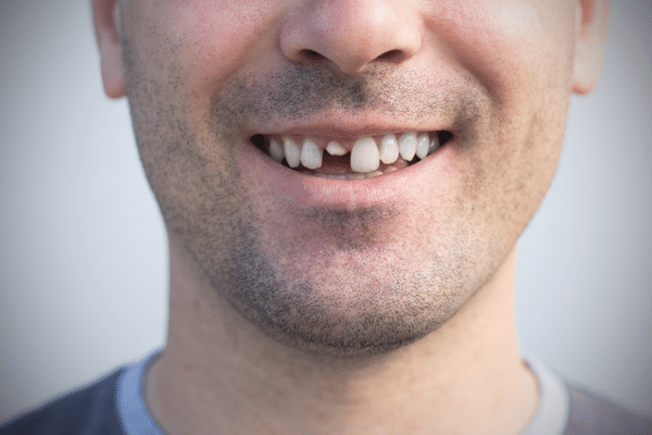 urgencias dentales en Algeciras, diente roto o perdido