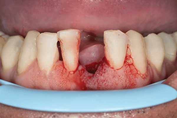 urgencias dentales en Algeciras, diente roto o perdido