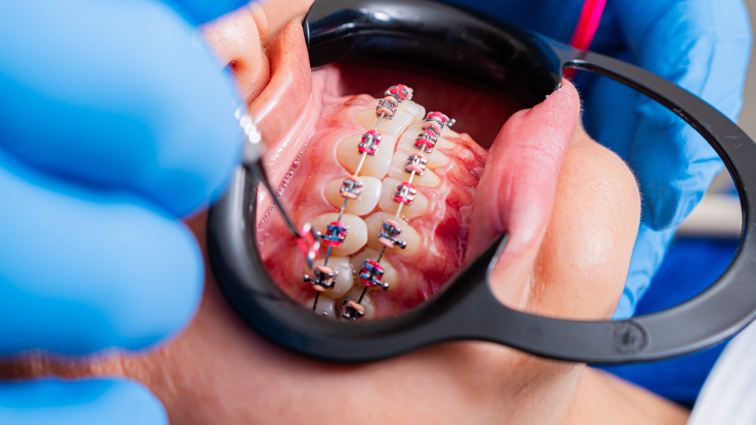 Ortodoncia en Algeciras en Clínica dental Colvi